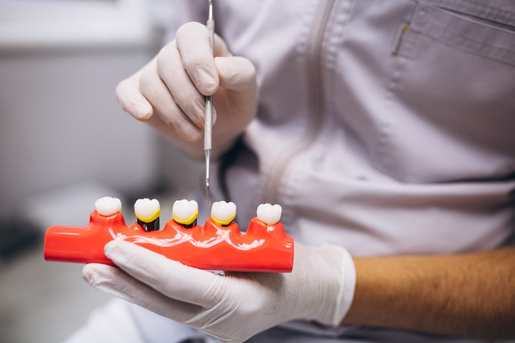 Dental Implant Costs in Turkey: What Affects the Price and How to Plan Your Visits