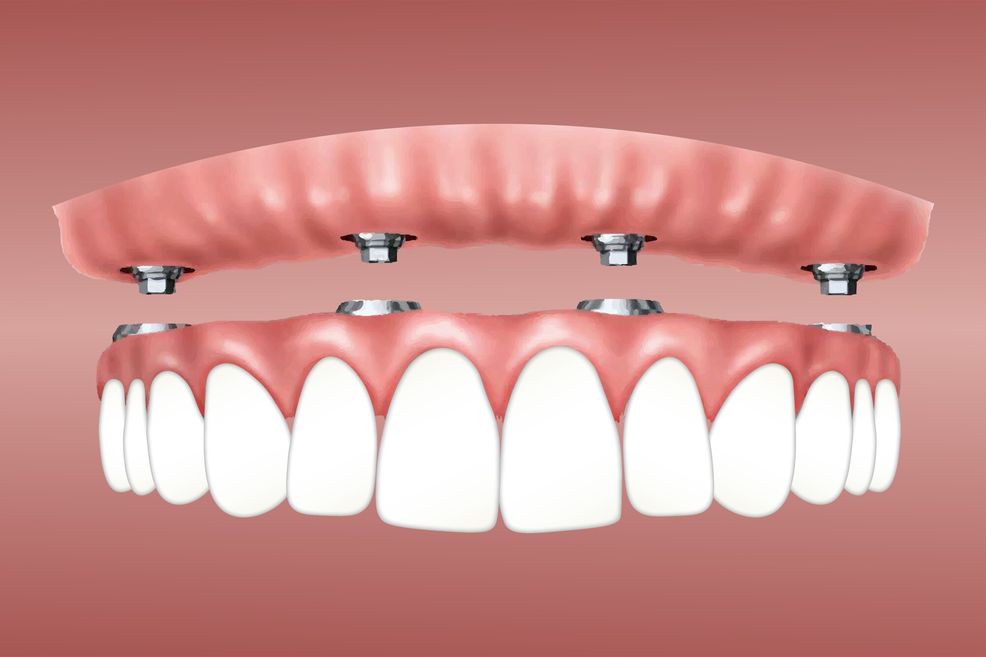 full-dental-implants